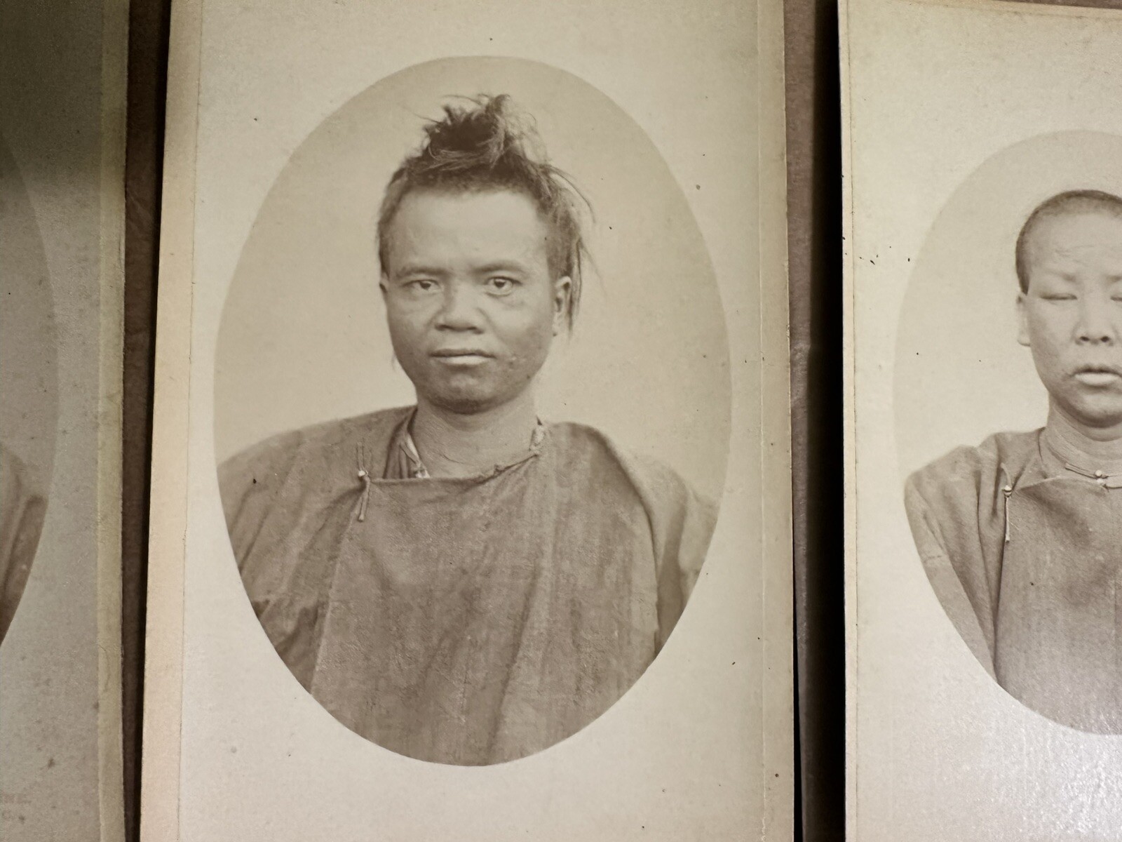 HISTORICALLY SIGNIFICANT CHINESE LEPERS SAN FRANCISCO RARE MEDICINE 19th Century