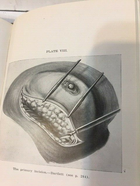 GENERAL SURGERY Ochsner Practical Medicine Series of 1918 Volume II Antique Book